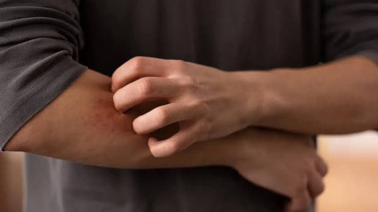 Dermatofilosi in aumento in Europa: Pregliasco rassicura, ma le modalità di trasmissione evolvono